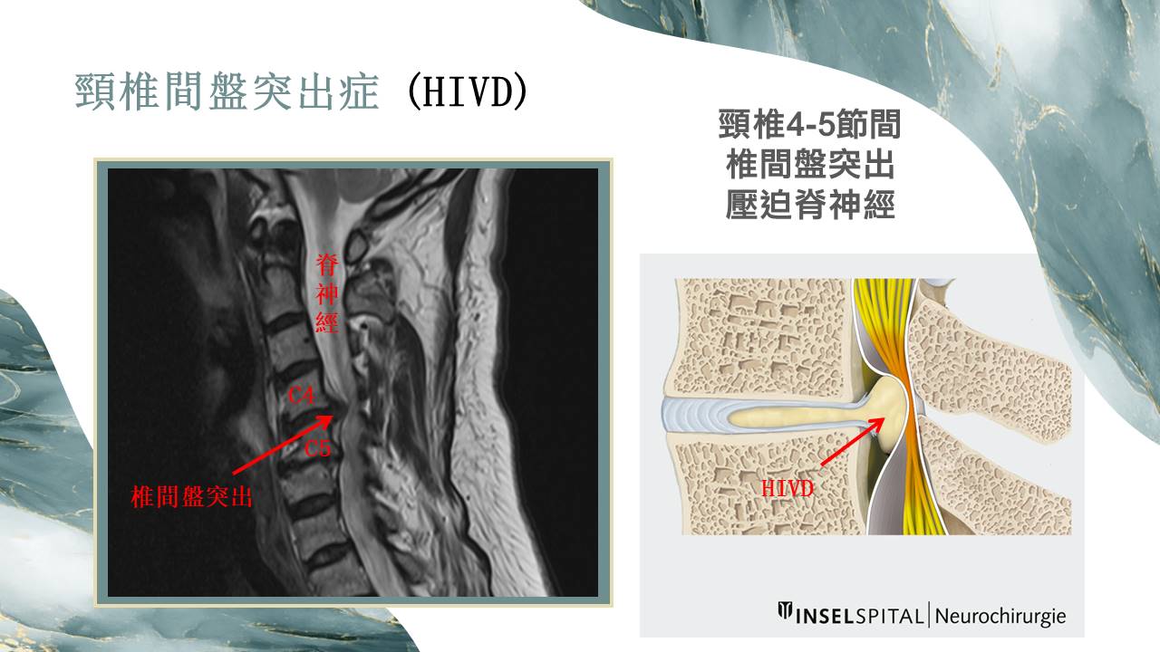 脊椎病患示意圖